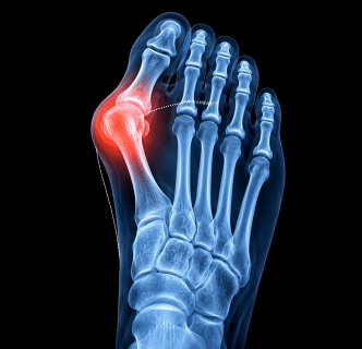 PureFeet™ BunionPro